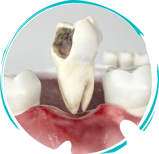 damaged tooth graphic