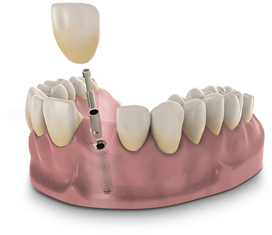 dental implant model