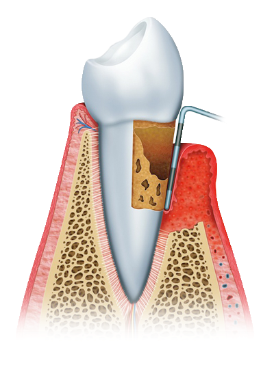 advanced periodontitis graphic