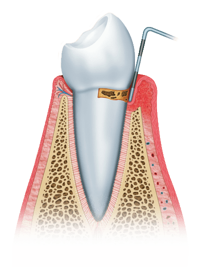 gingivitis graphic