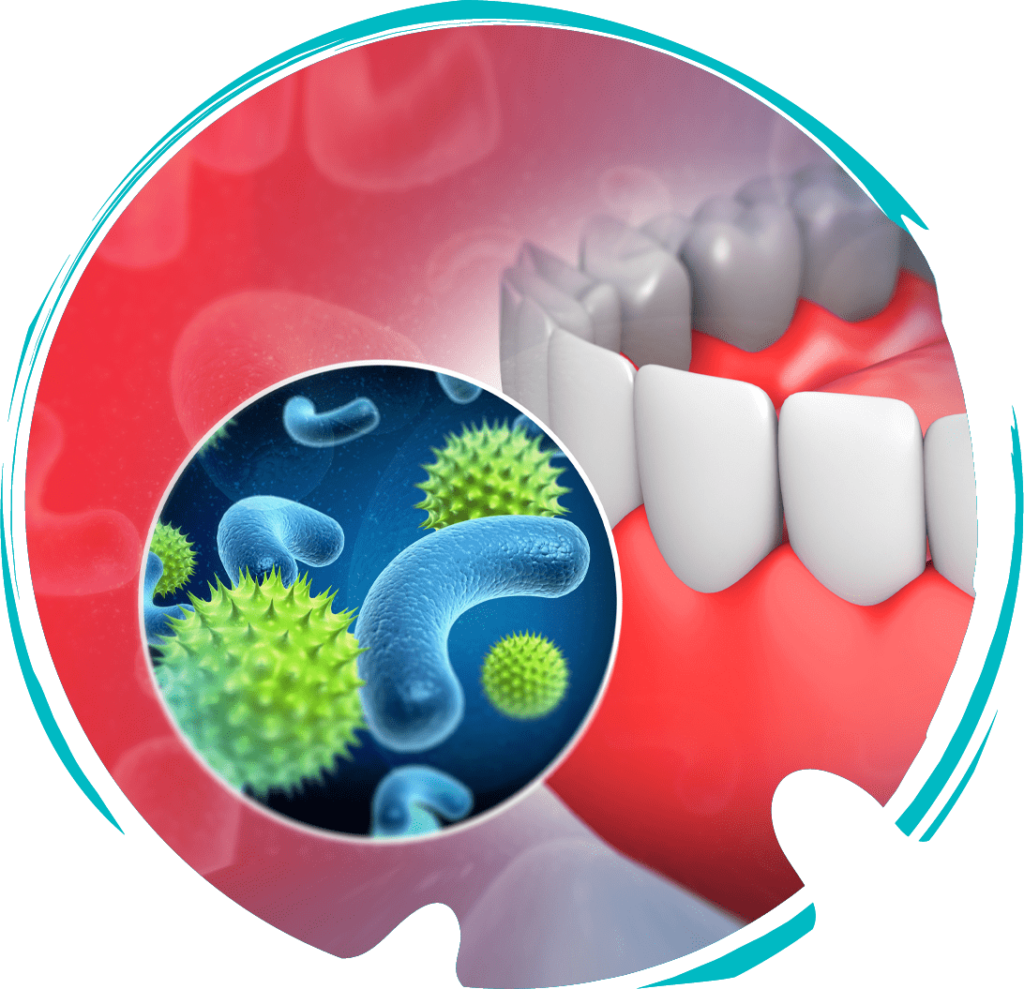 periodontal disease graphic
