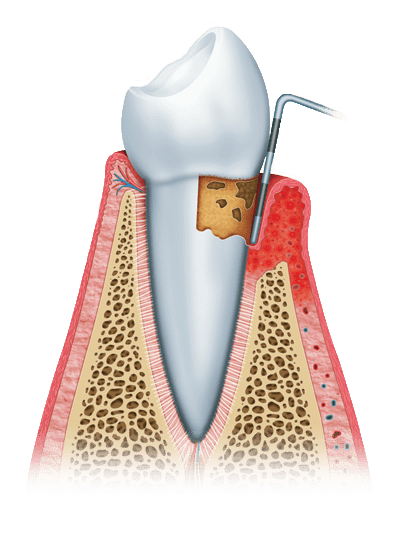 periodontitis graphic